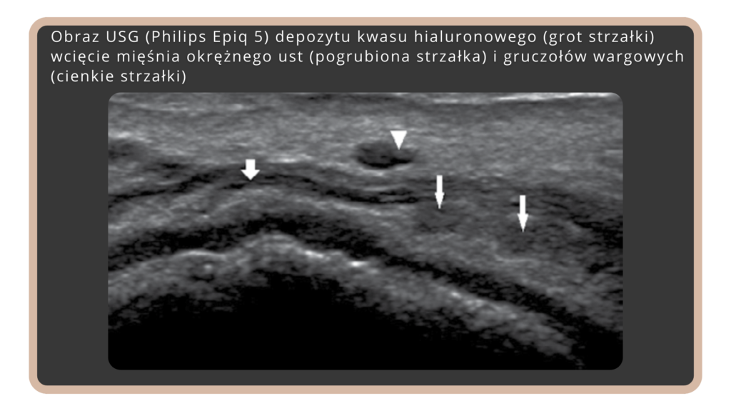 Ocena ultrasonograficzna wysokiej częstotliwości gruczołów wargowych symulujących małe guzki lub ziarniniaki po powiększaniu ust