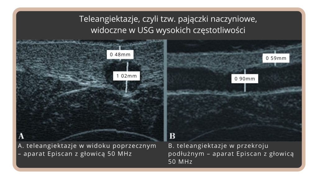 Zastosowanie ultrasonografii wysokiej częstotliwości w zamykaniu małych naczyń krwionośnych